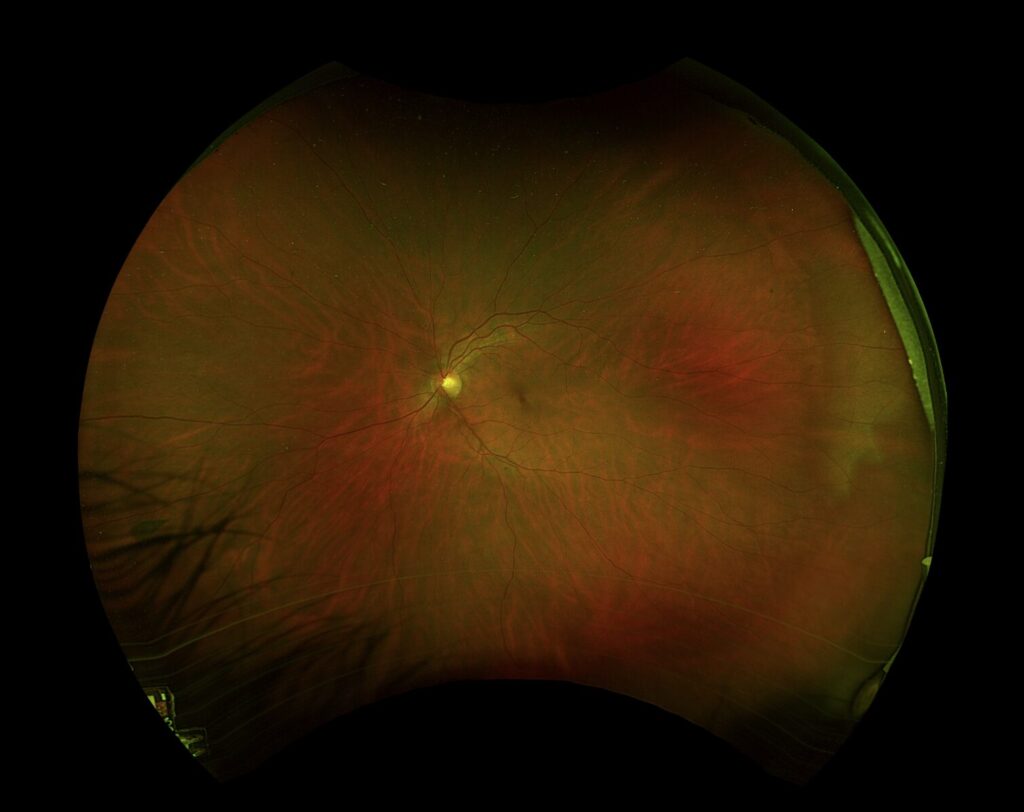 Ophthalmic optical imaging displaying a fundus photograph for clinical trial evaluation.