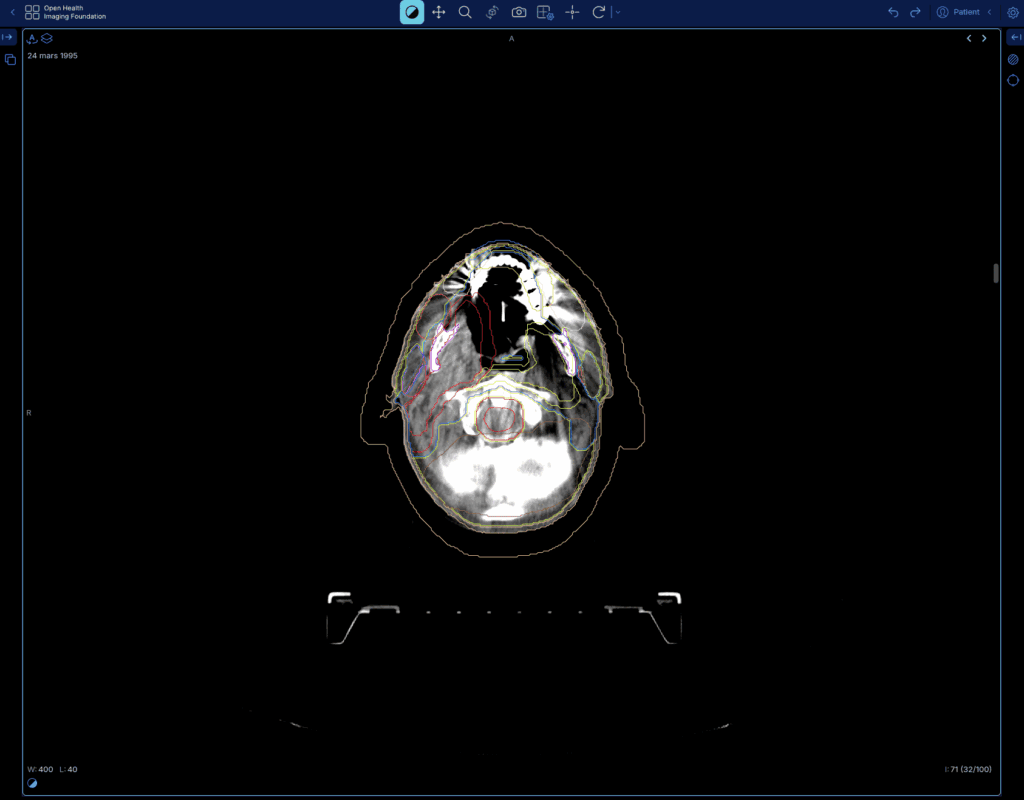 Radiotherapy treatment planning showing tumoral contouring and radiation dose distribution curves within the GaelO interface.