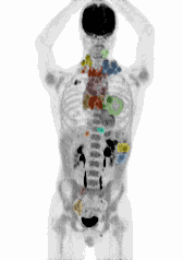 Rotating 3D PET MIP (Maximum Intensity Projection) animation showing automated multi-color tumor segmentation and metabolic volume extraction.
