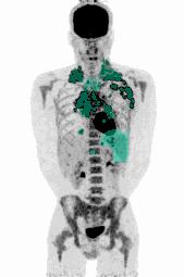 AI segmentation algorithms — FDG, PSMA, DOTATOC tracers for medical imaging